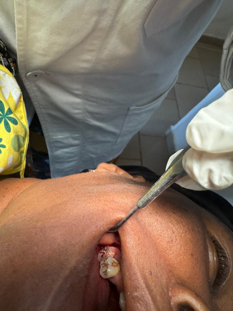 Vue complémentaire de la dent 17 avant extraction