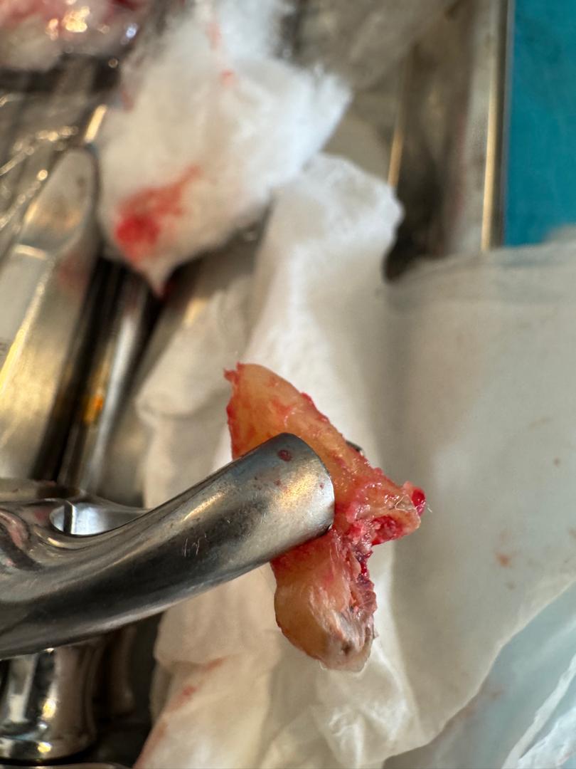 Dent 17 après son extraction