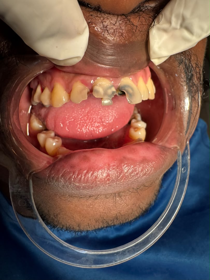 Polycaries des dents 11, 12 et 21 avec destruction importante du tissu amélaire