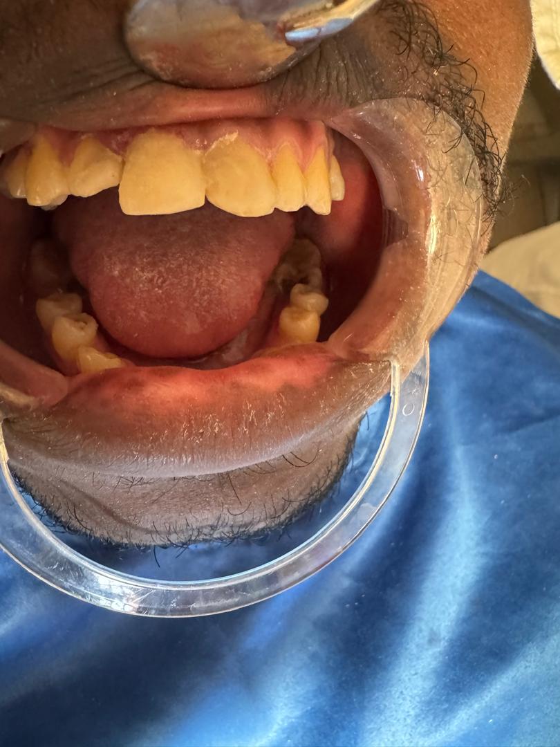 Résultat après restaurations composites et traitement endodontique de la dent 11 avec tenon en fibre de verre